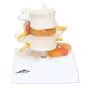 Lumbar Spinal Column with Prolapsed Intervertebral Disc A76