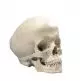Hydrocephalic Human Skull A29/2