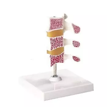 Deluxe Osteoporosis Model (3 Vertebrae) A78