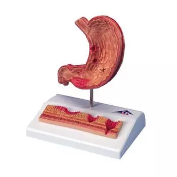 Stomach with Ulcers model K17