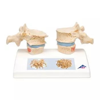 Osteoporosis Model A95