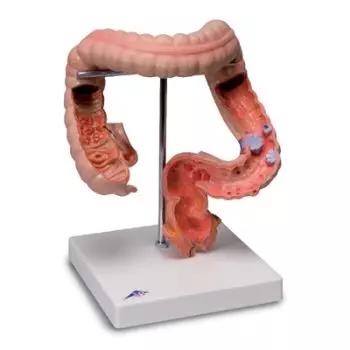 Intestinal diseases K55