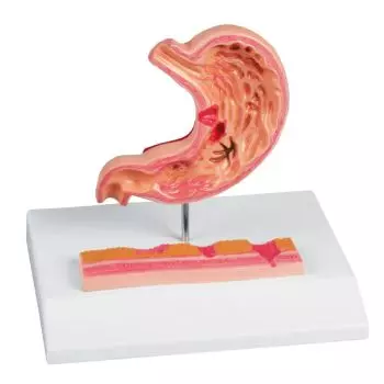 Stomach with Ulcers Erler Zimmer