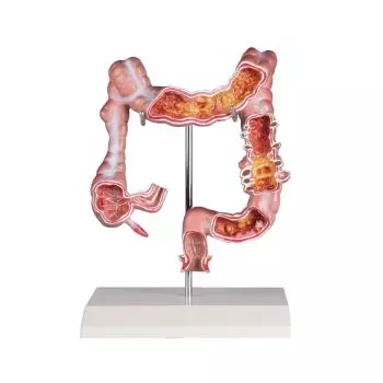 Colon model with disease Erler Zimmer