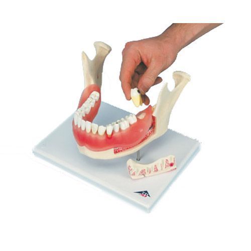 Twice enlarged diseased dental model 21 parts D26