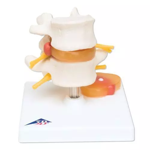 Lumbar Spinal Column with Prolapsed Intervertebral Disc A76