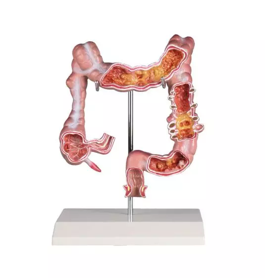 Colon model with disease Erler Zimmer