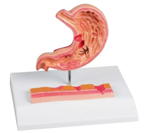 Stomach with Ulcers Erler Zimmer