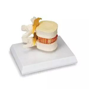 Herniated Disc Simulator W22230